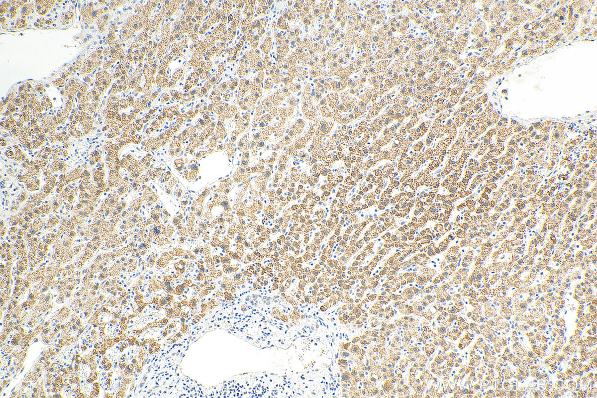 IHC staining of human liver cancer using 18703-1-AP