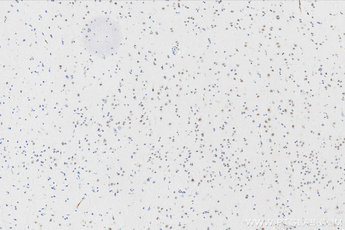 IHC staining of Human brain cancer（Astrocitoma） using 86513-3-RR