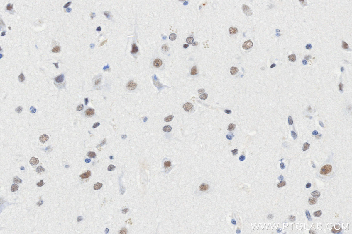 IHC staining of Human brain cancer（Astrocitoma） using 86513-3-RR