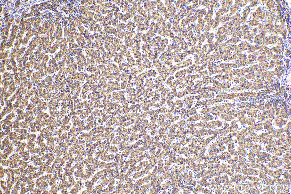 IHC staining of human liver cancer using 15184-1-AP