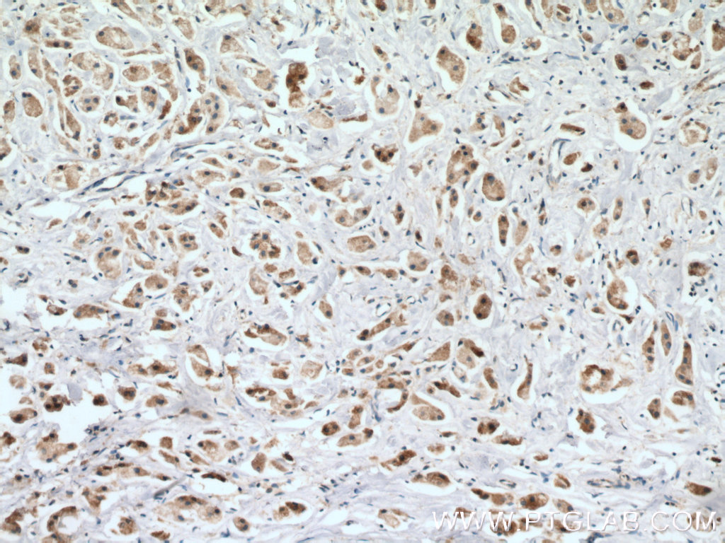 IHC staining of human breast cancer using 66039-1-Ig (same clone as 66039-1-PBS)