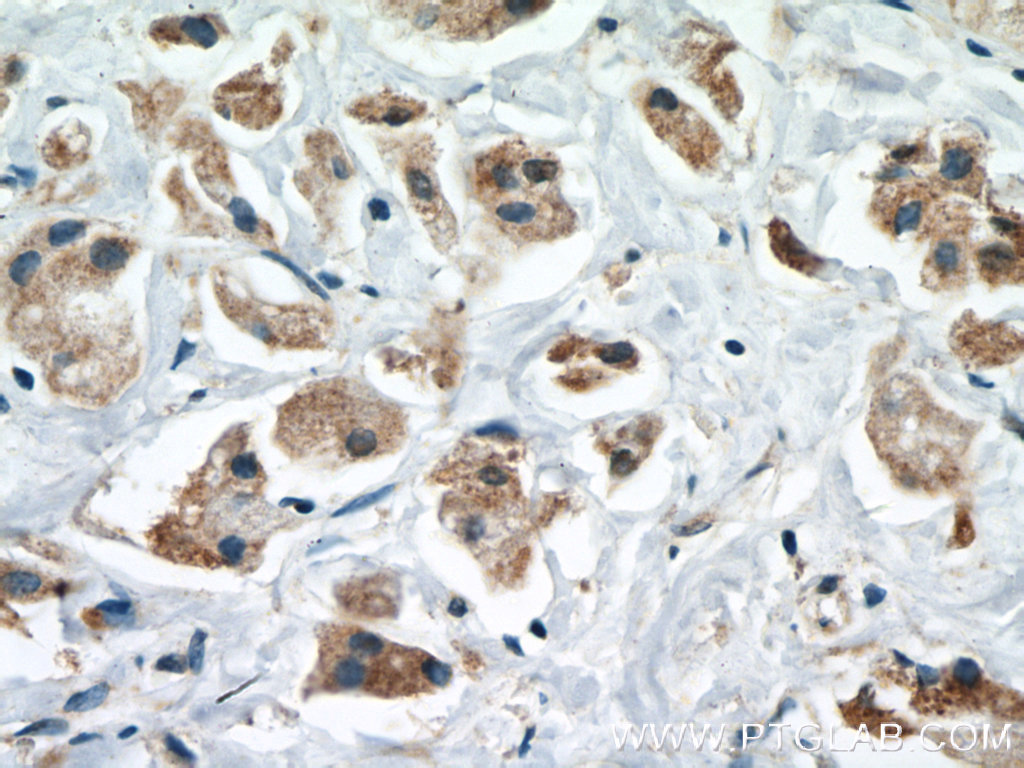 IHC staining of human breast cancer using 66039-1-Ig