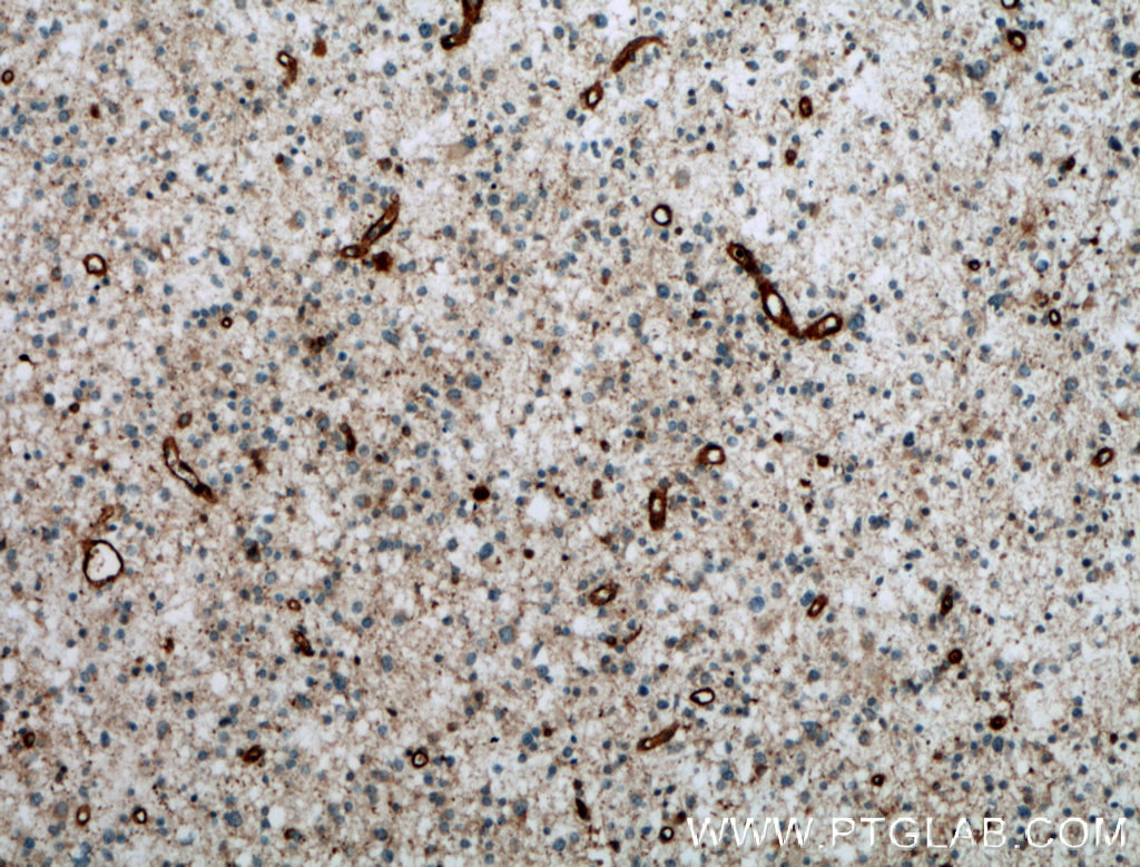 IHC staining of human gliomas using 12969-1-AP