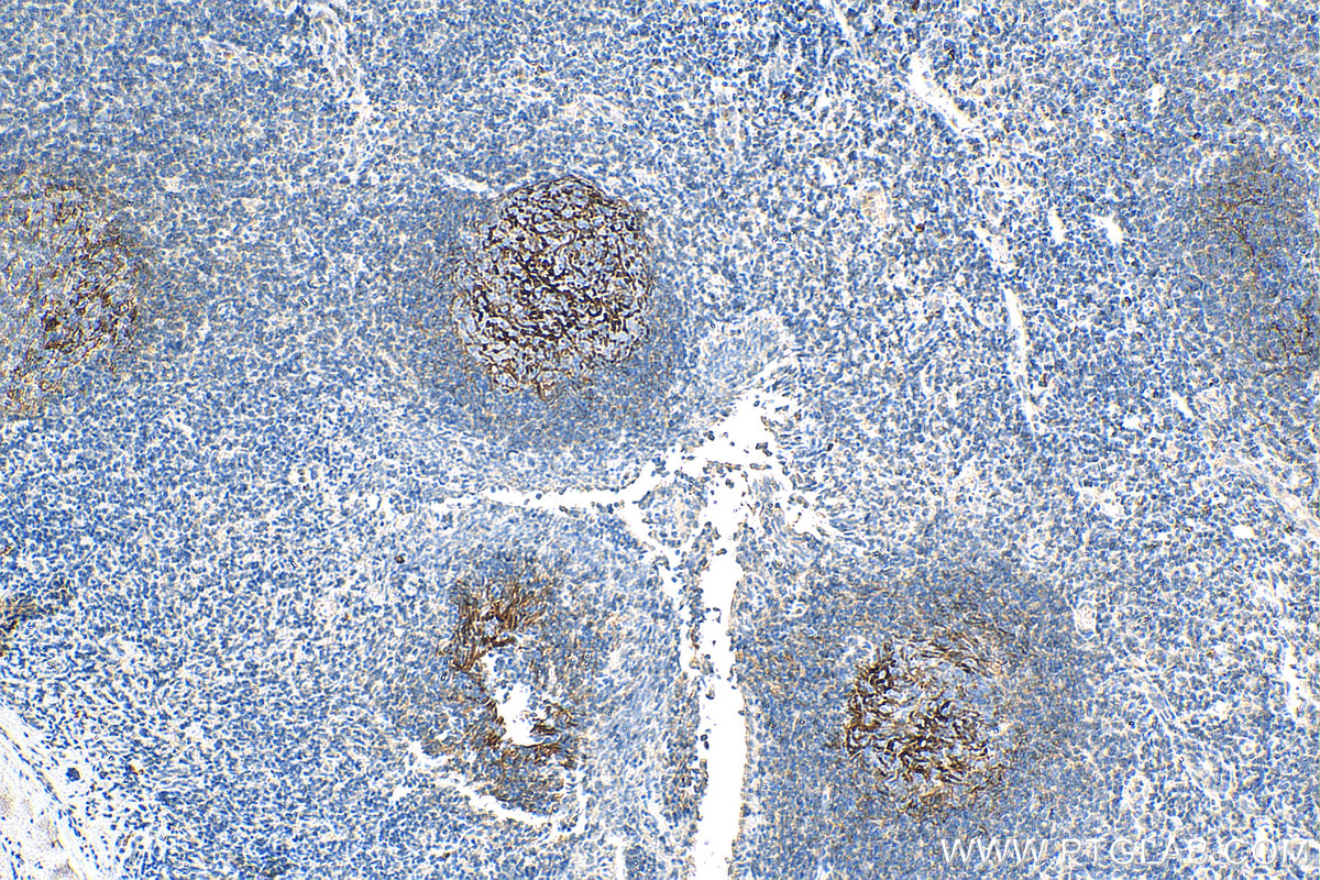IHC staining of human tonsillitis using 68033-1-Ig
