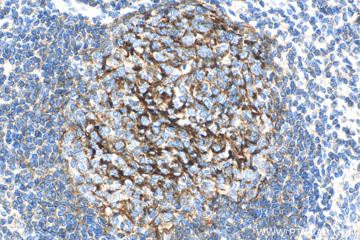 IHC staining of human tonsillitis using 68033-1-Ig