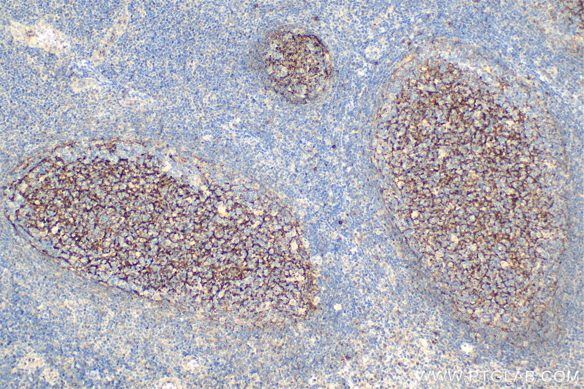IHC staining of human tonsillitis using 68033-1-Ig