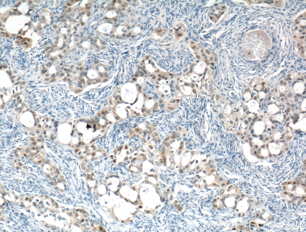 IHC staining of human ovary tumor using 66468-1-Ig