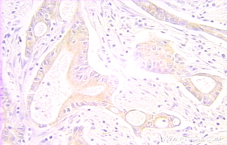 IHC staining of human colon cancer using 10401-1-AP