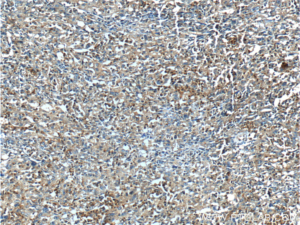 IHC staining of human cervical cancer using 11435-1-AP