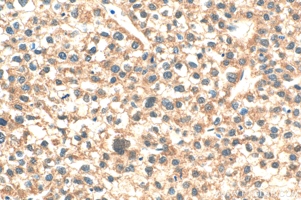 IHC staining of human liver cancer using 28494-1-AP
