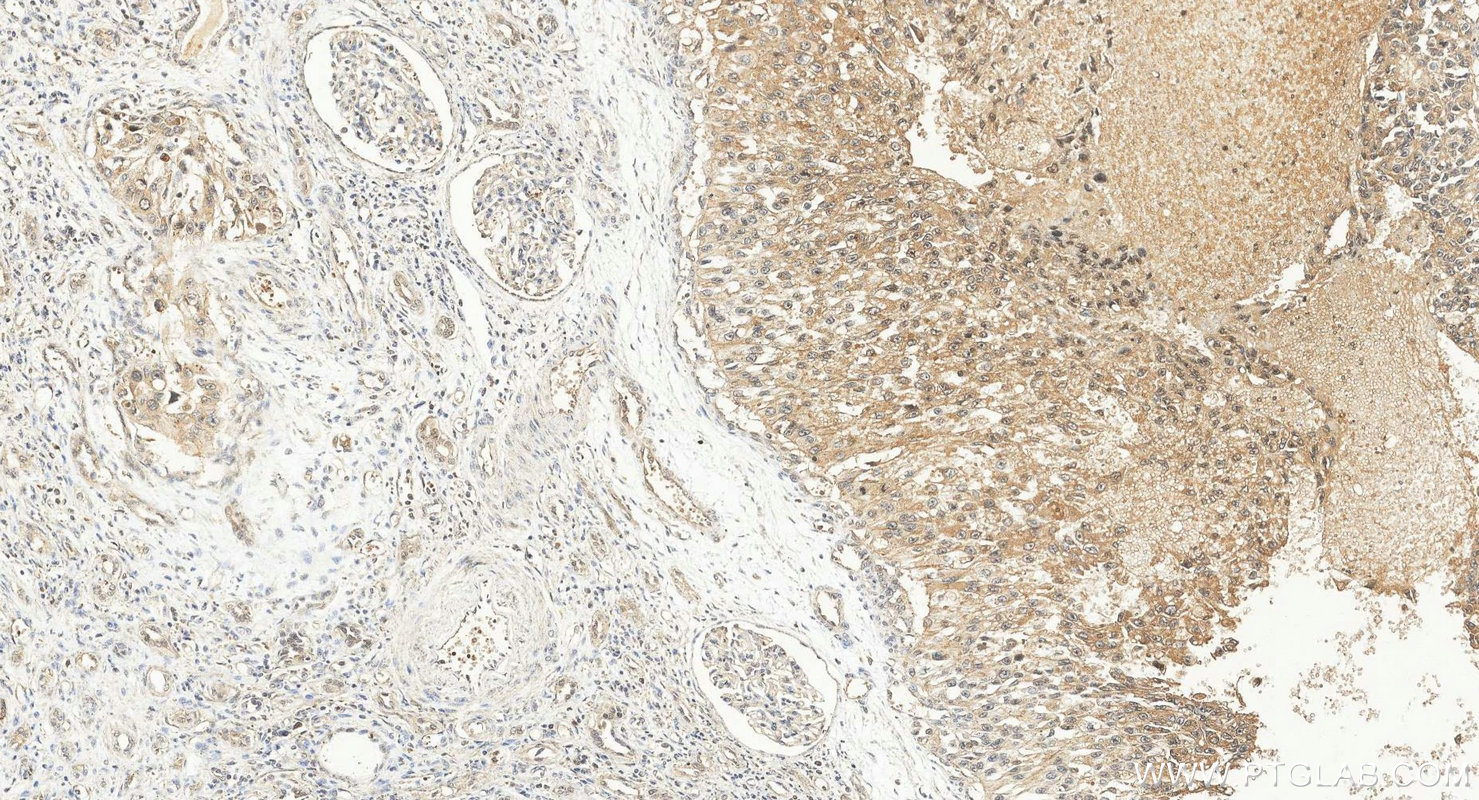 IHC staining of human renal cell carcinoma using 11235-2-AP IHC staining of human renal cell carcinoma using 11235-2-AP