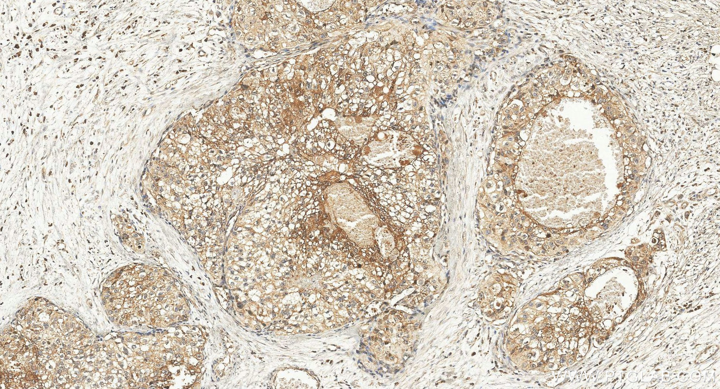 IHC staining of human renal cell carcinoma using 11235-2-AP IHC staining of human renal cell carcinoma using 11235-2-AP