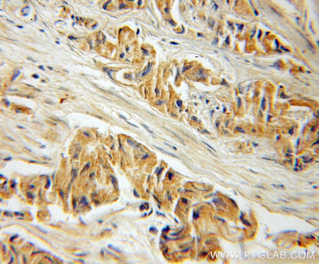IHC staining of human prostate cancer using 11235-2-AP