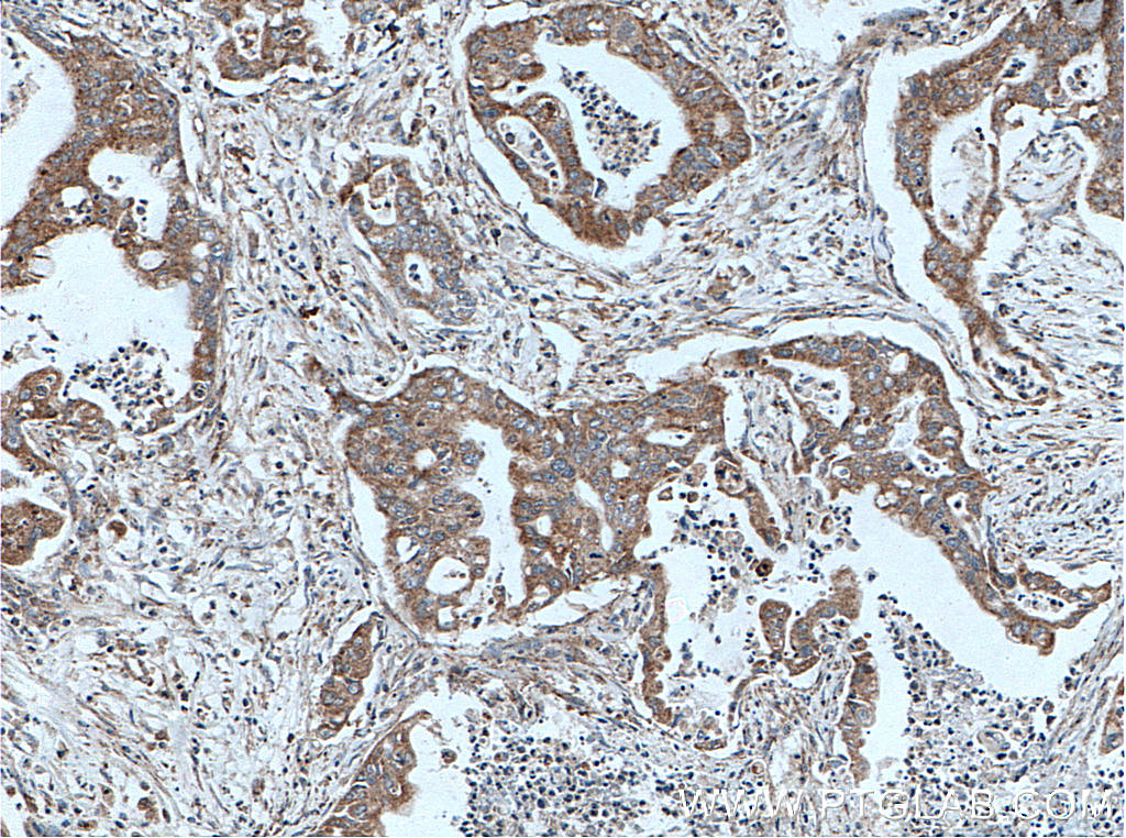 IHC staining of human pancreas cancer using 10944-1-AP