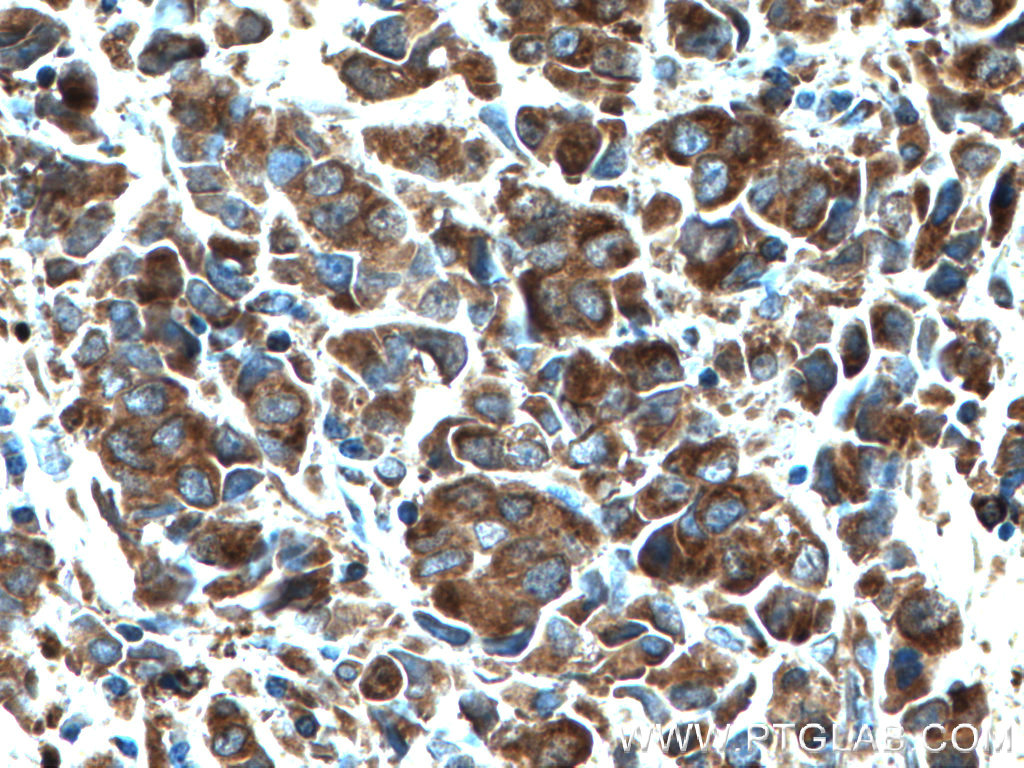 IHC staining of human prostate cancer using 14847-1-AP