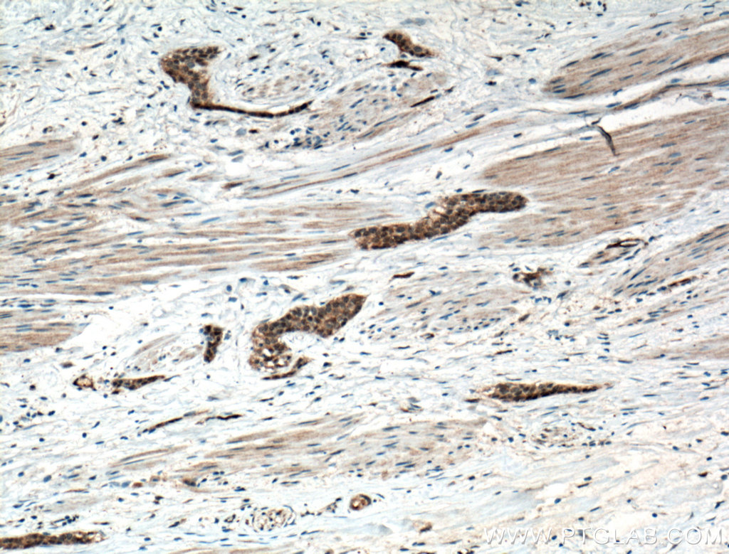IHC staining of human urothelial carcinoma using 16685-1-AP