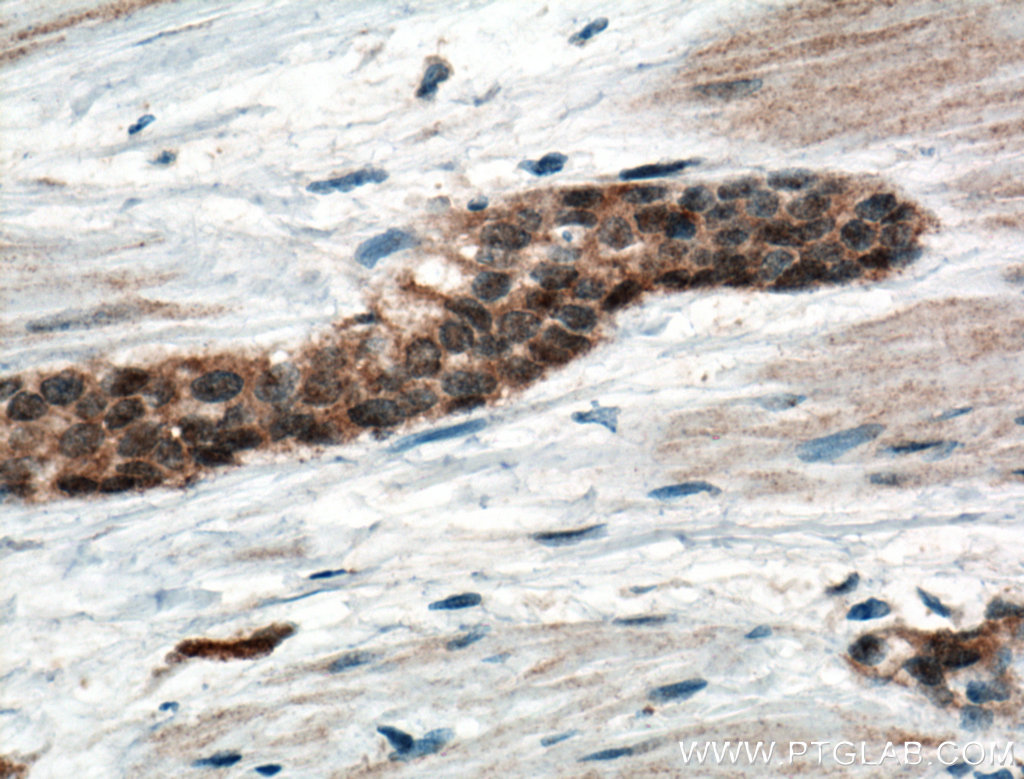 IHC staining of human urothelial carcinoma using 16685-1-AP