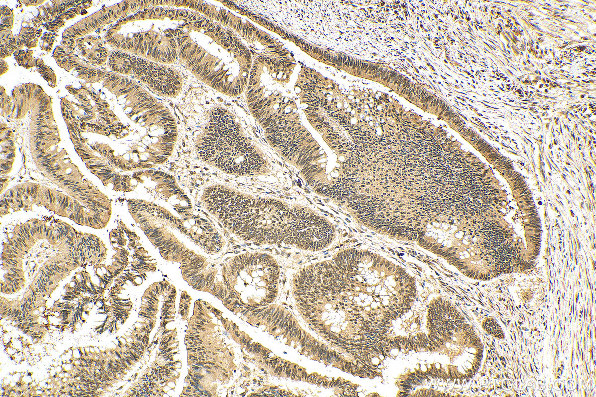 IHC staining of human colon cancer using 27917-1-AP