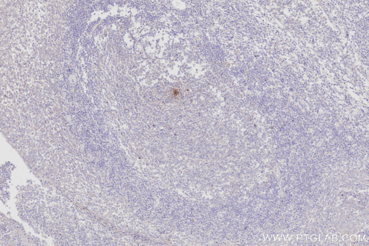 IHC staining of human tonsillitis using 11799-1-AP IHC staining of human tonsillitis using 11799-1-AP
