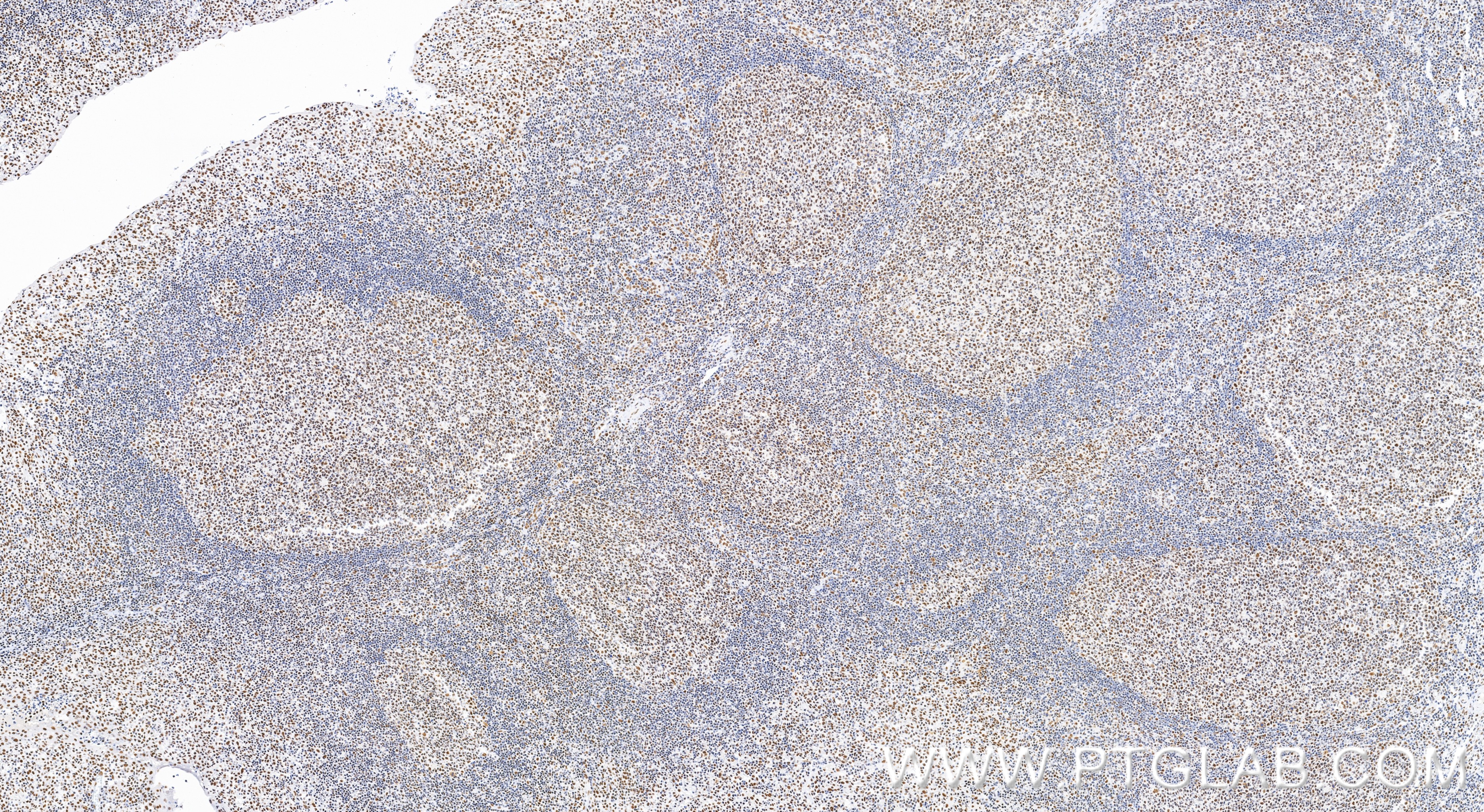 IHC staining of human tonsillitis using 86690-1-RR