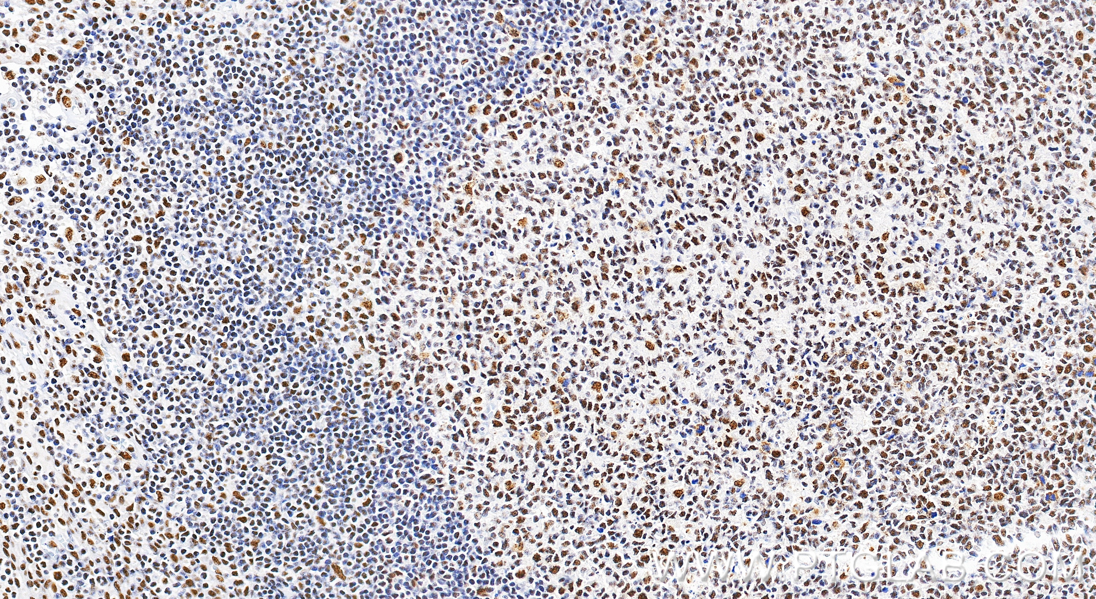 IHC staining of human tonsillitis using 86690-1-RR