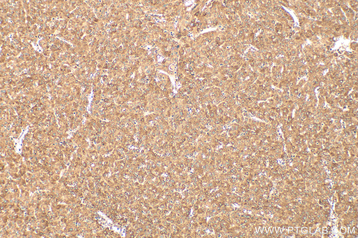 IHC staining of human liver cancer using 13543-1-AP