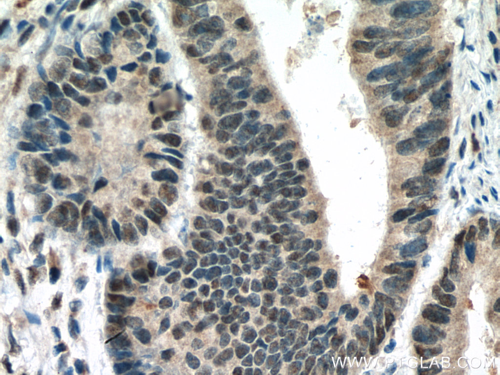 IHC staining of human colon cancer using 10441-1-AP