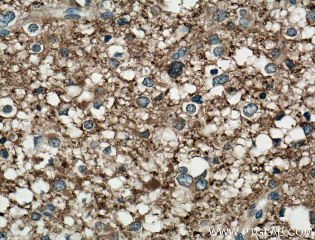 IHC staining of human gliomas using 12495-1-AP