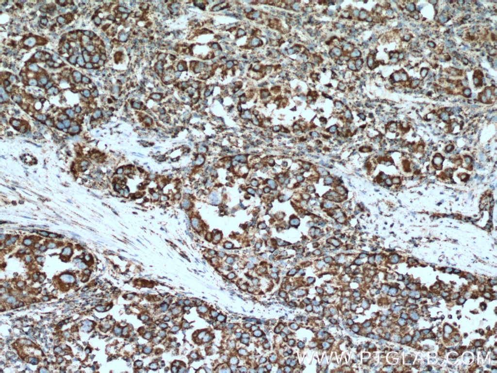 IHC staining of human liver cancer using 16131-1-AP