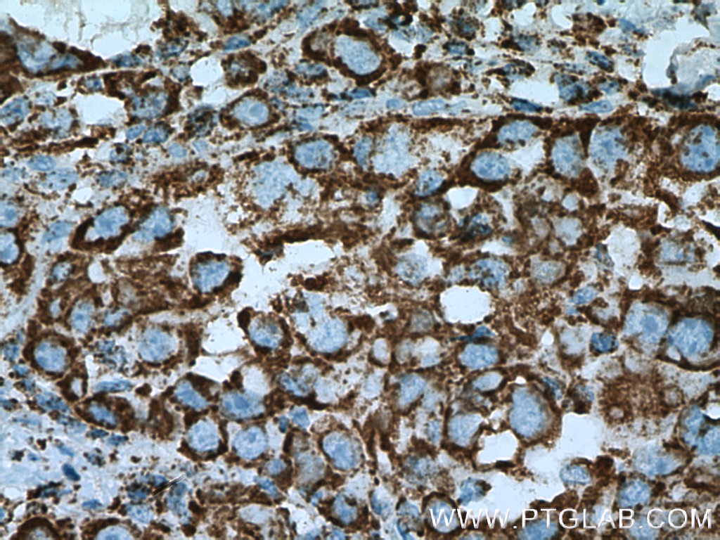 IHC staining of human liver cancer using 16131-1-AP