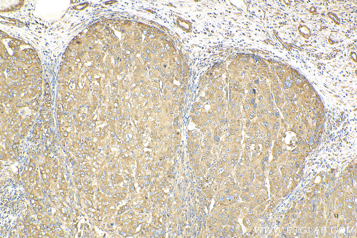 IHC staining of human liver cancer using 13319-1-AP