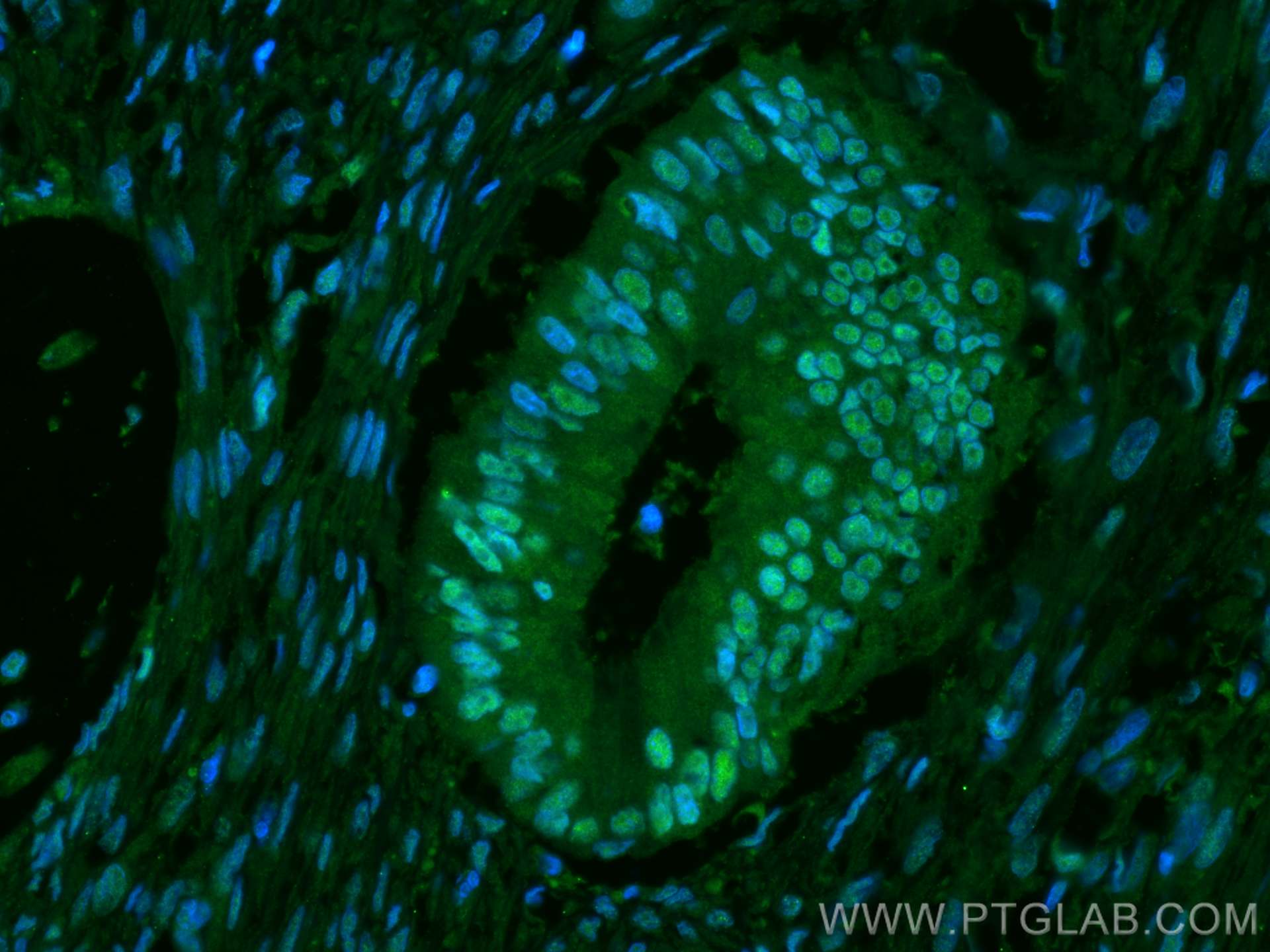 IF Staining of human colon cancer using 67306-1-Ig (same clone as 67306-1-PBS)