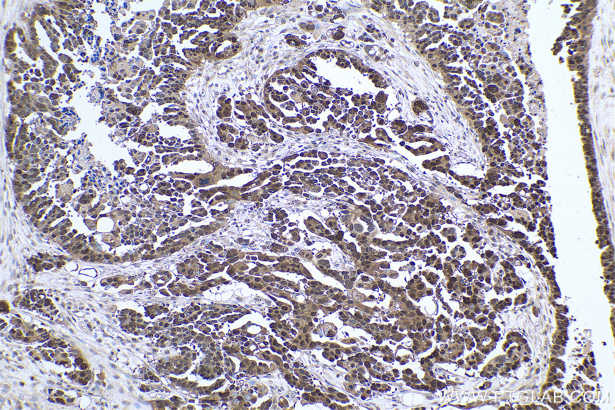 IHC staining of human colon cancer using 67306-1-Ig