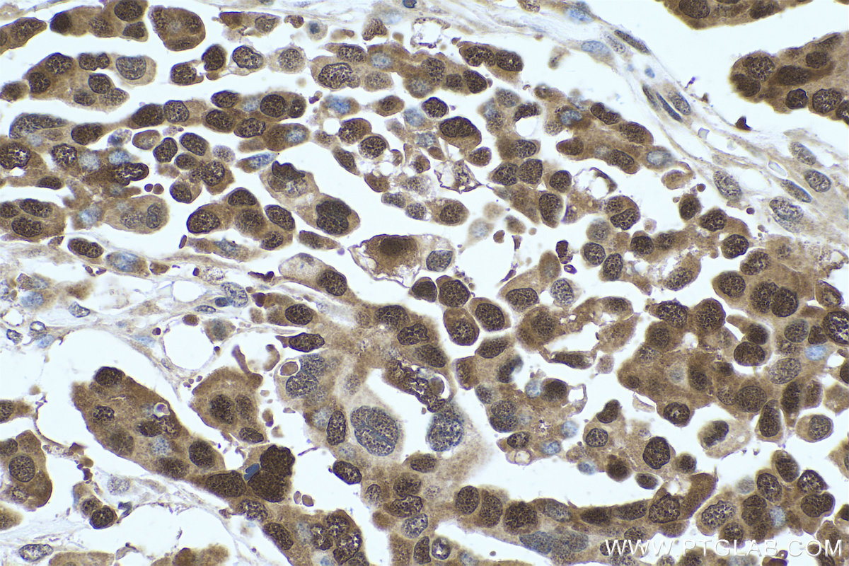 IHC staining of human colon cancer using 67306-1-Ig