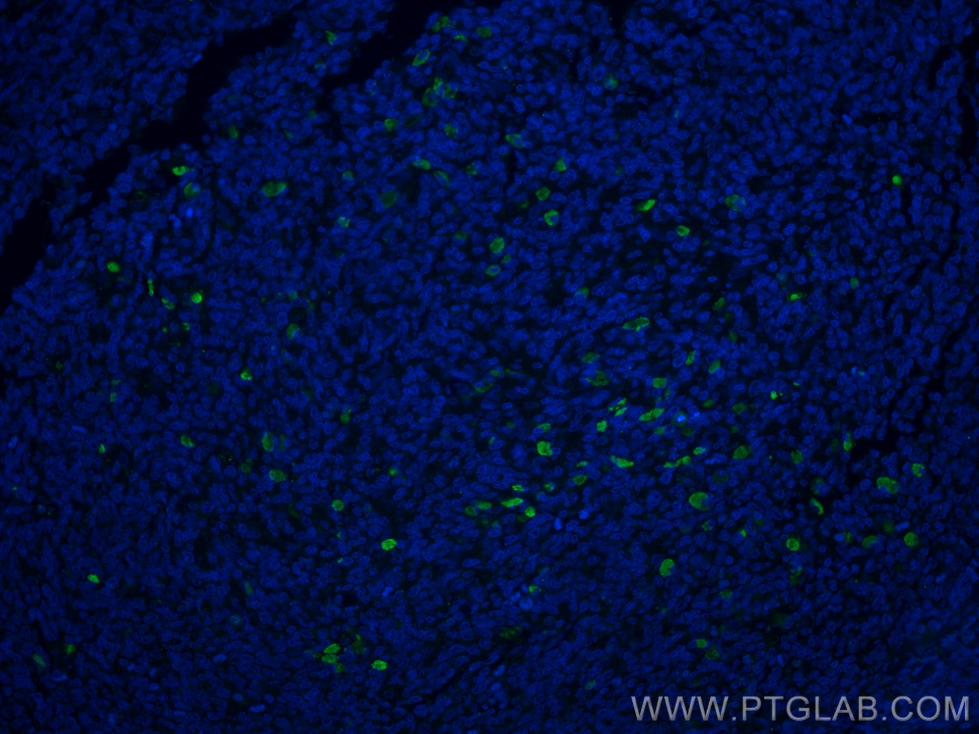 IF Staining of human tonsillitis using 25949-1-AP