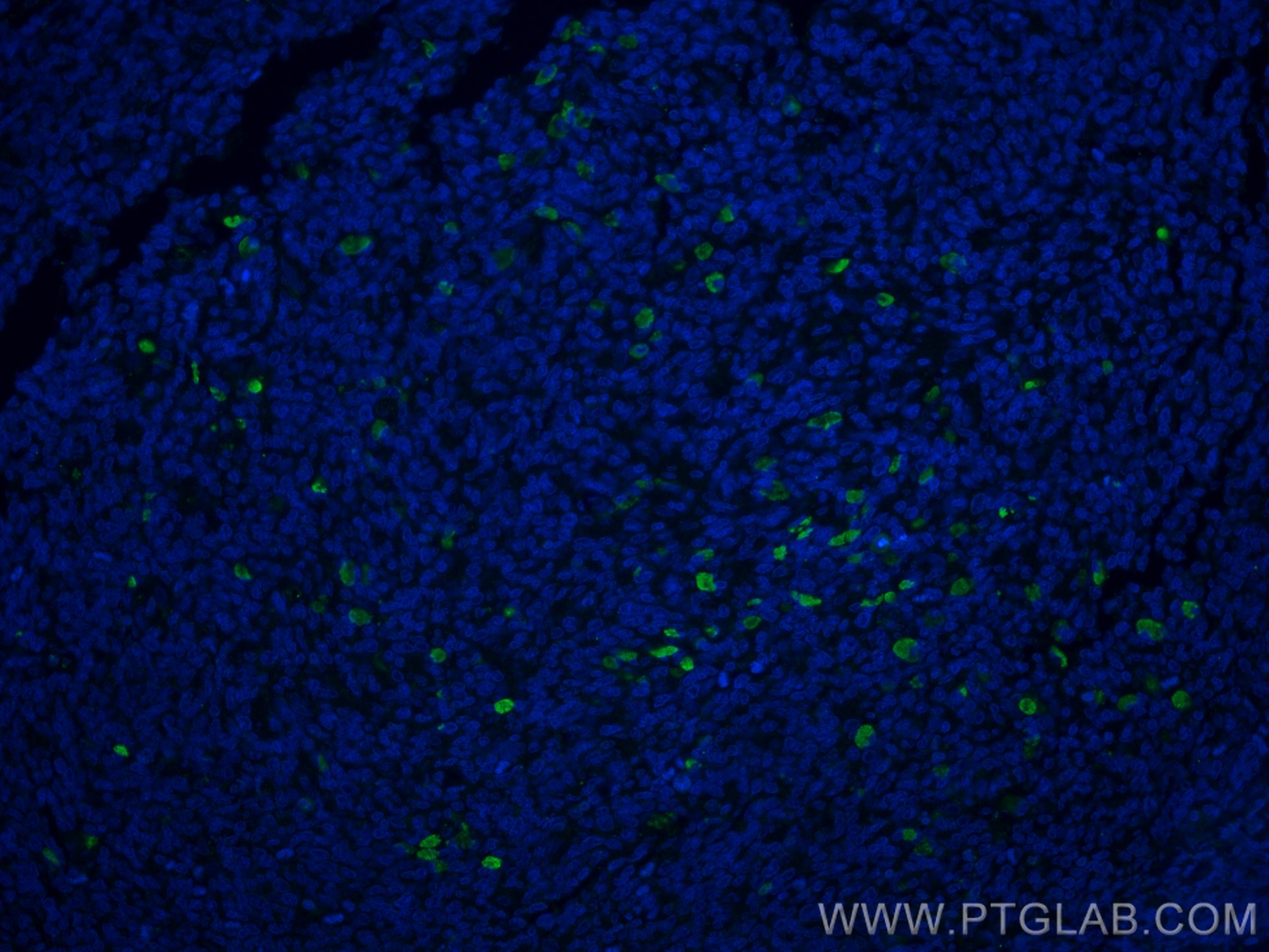 IF Staining of human tonsillitis using 25949-1-AP