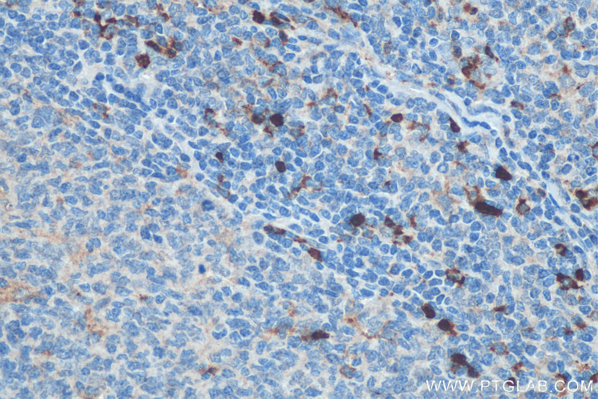 IHC staining of human tonsillitis using 17762-1-AP