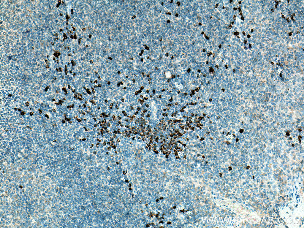 IHC staining of human tonsillitis using 27148-1-AP