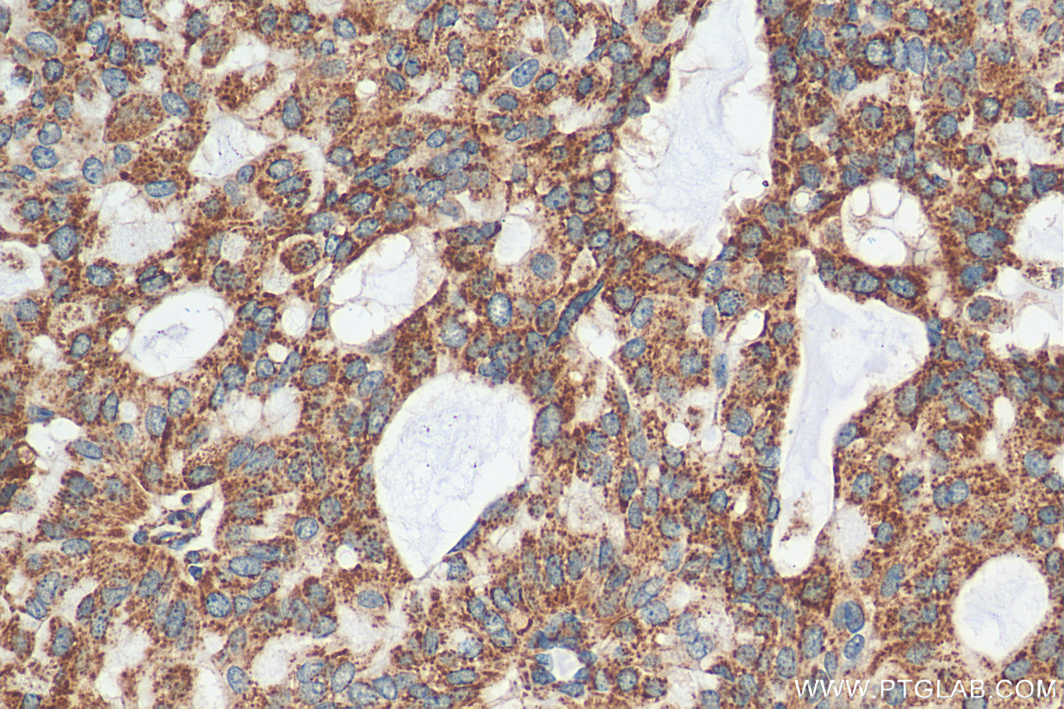 IHC staining of human breast hyperplasia using 30498-1-AP