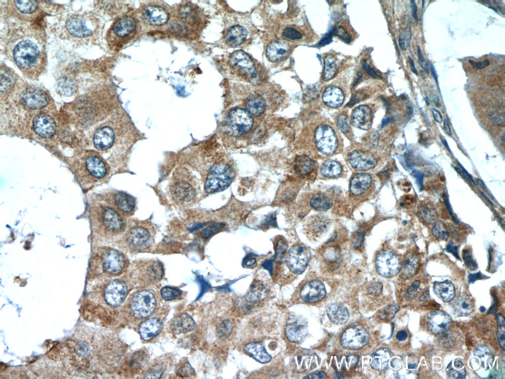 IHC staining of human breast cancer using 16032-1-AP