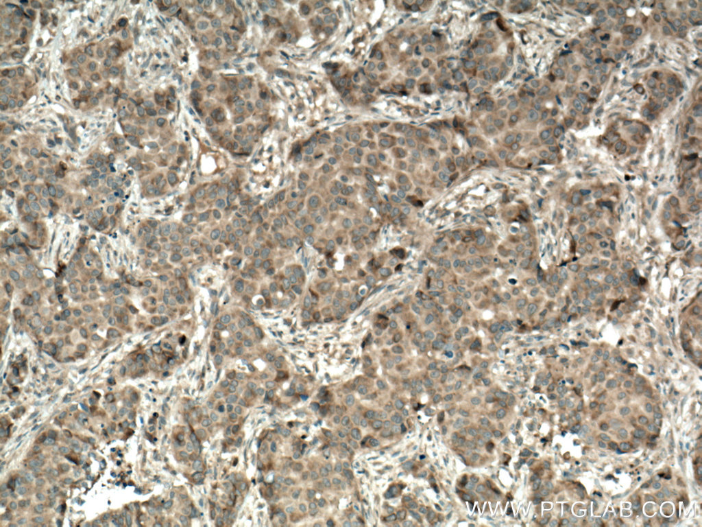 IHC staining of human breast cancer using 55192-1-AP