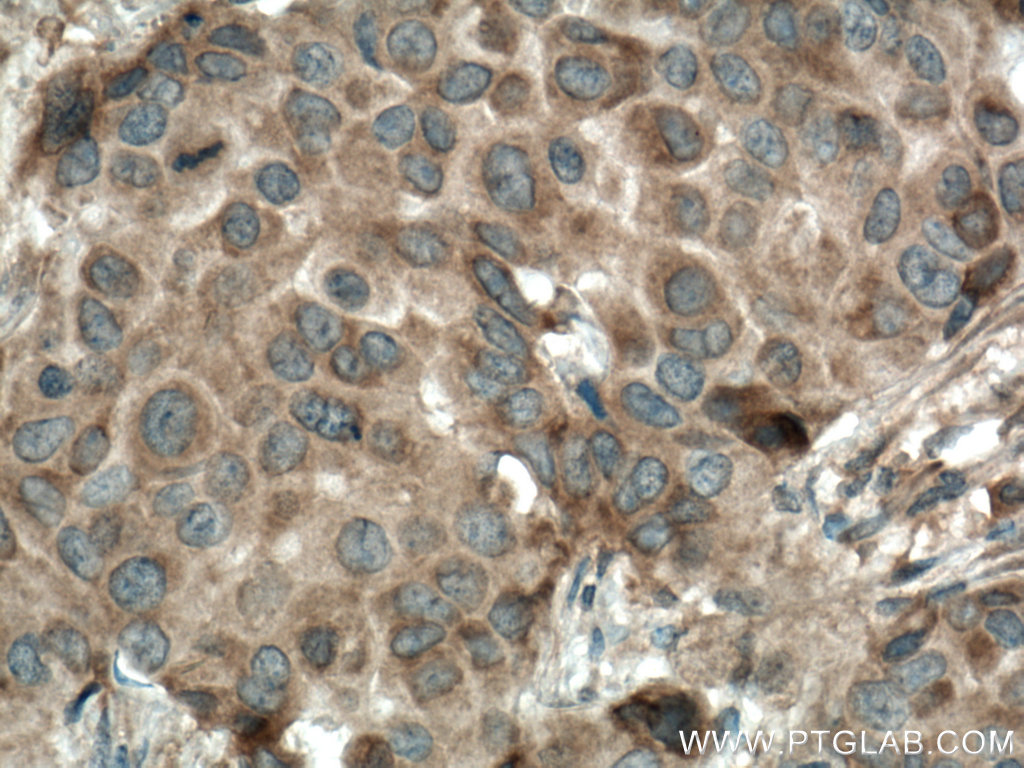 IHC staining of human breast cancer using 55192-1-AP