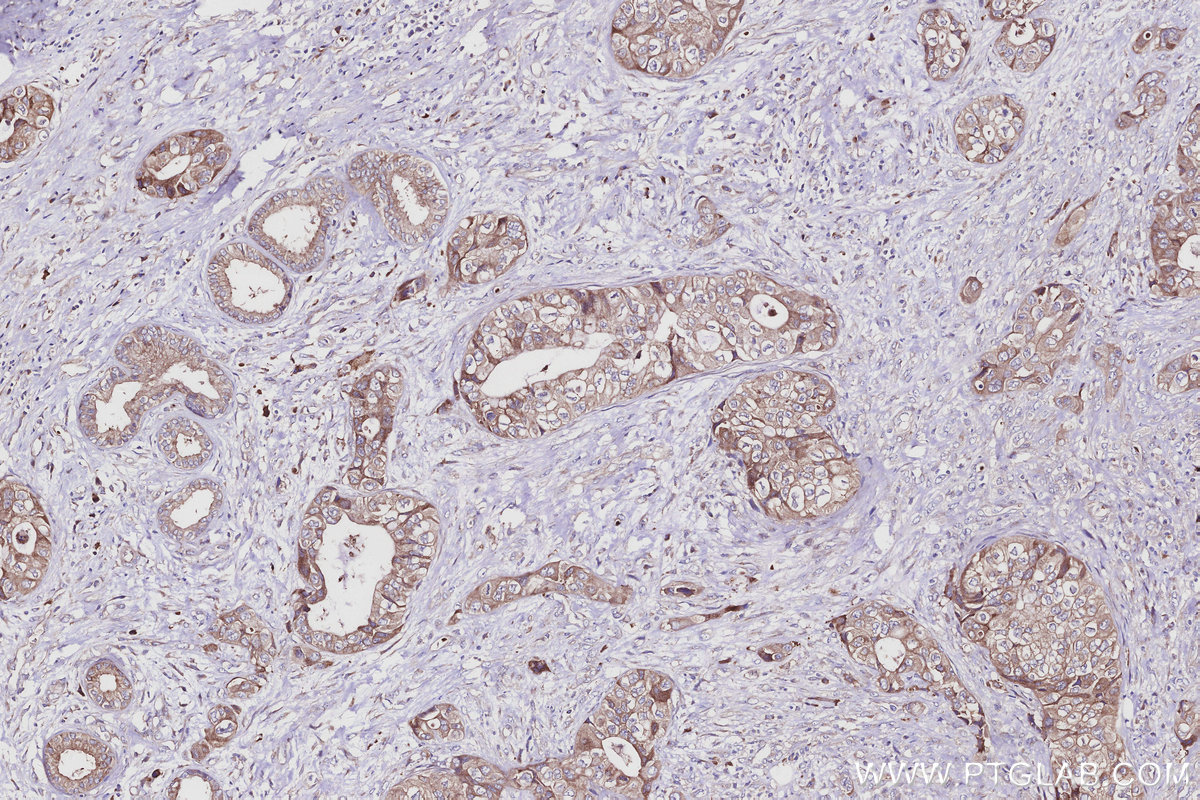 IHC staining of human pancreas cancer using 16384-1-AP IHC staining of human pancreas cancer using 16384-1-AP
