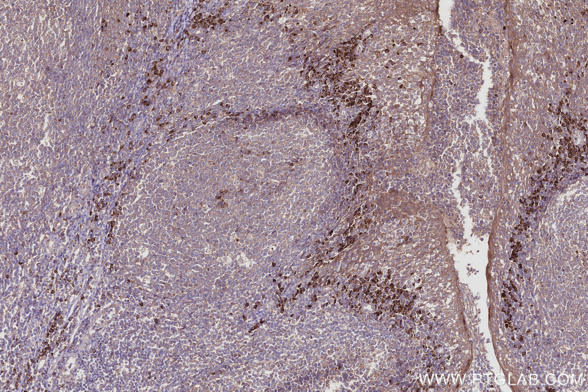 IHC staining of human tonsillitis using 16384-1-AP IHC staining of human tonsillitis using 16384-1-AP