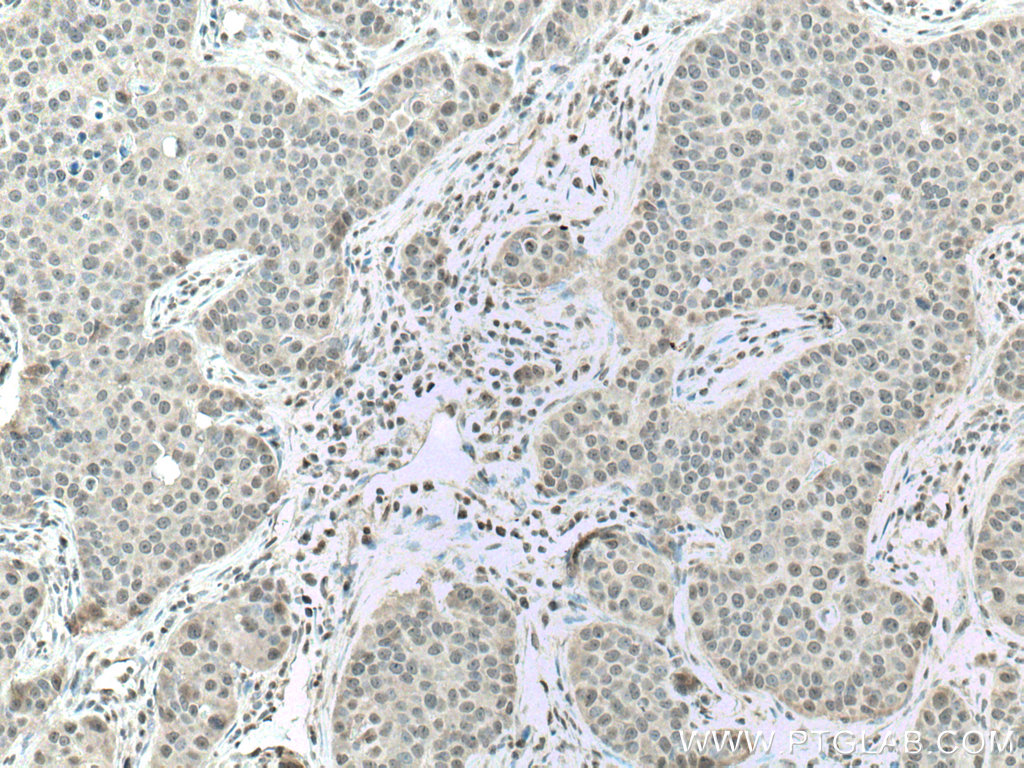 IHC staining of human breast cancer using 10992-1-AP