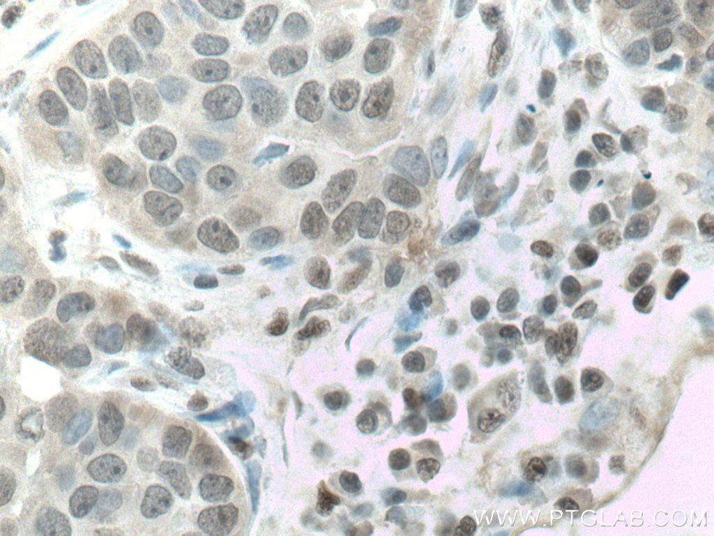 IHC staining of human breast cancer using 10992-1-AP