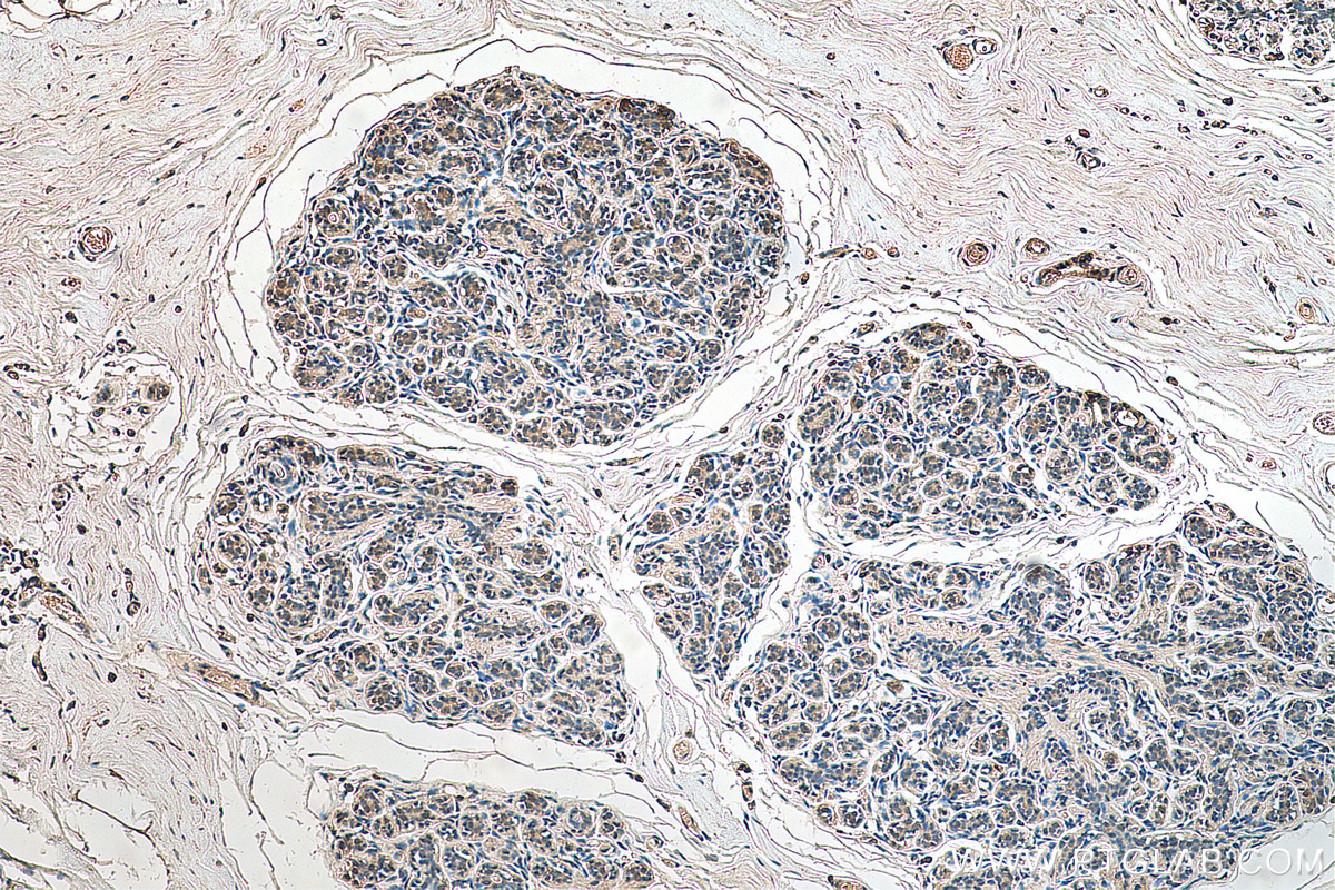 IHC staining of human breast cancer using 67866-1-Ig