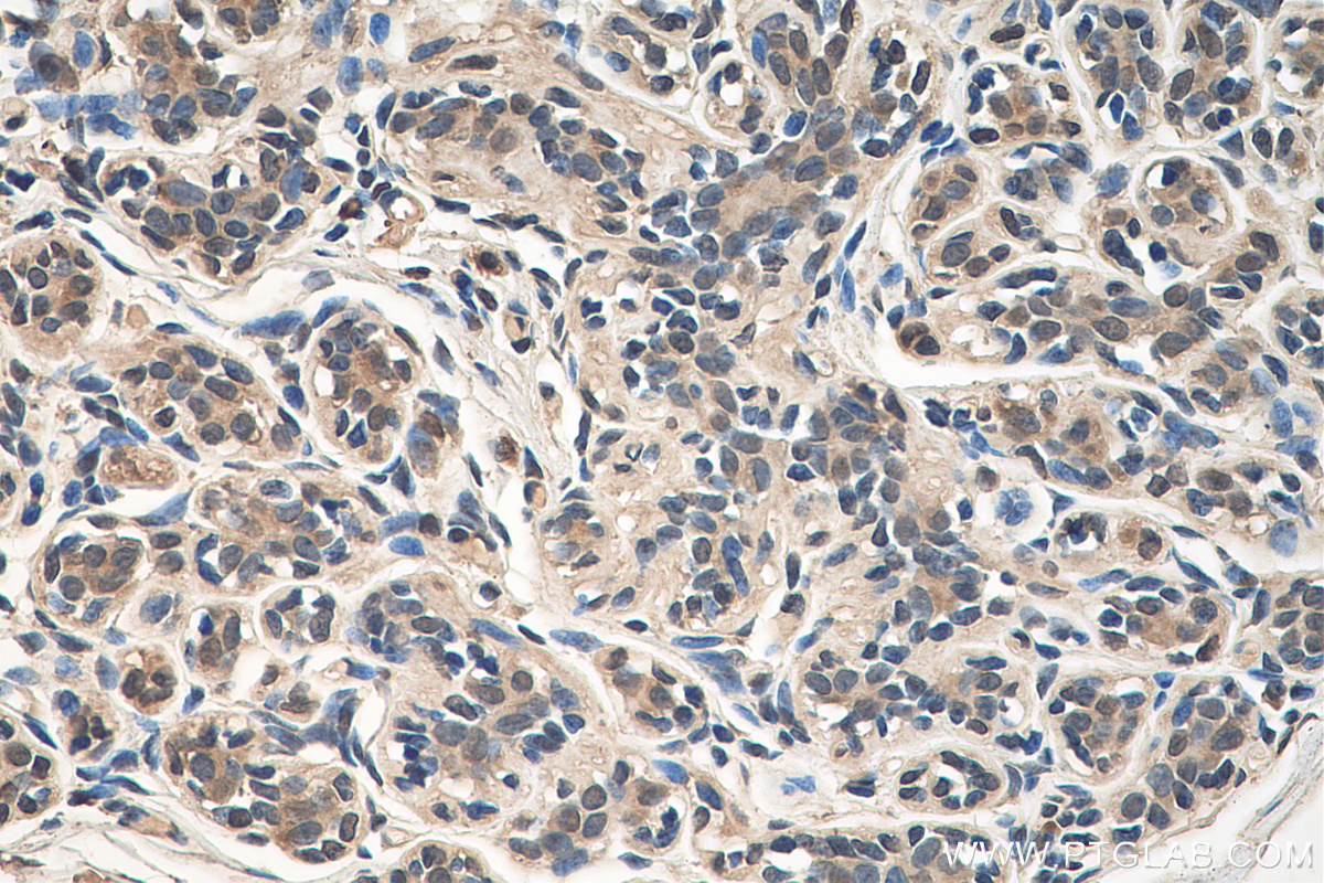 IHC staining of human breast cancer using 67866-1-Ig