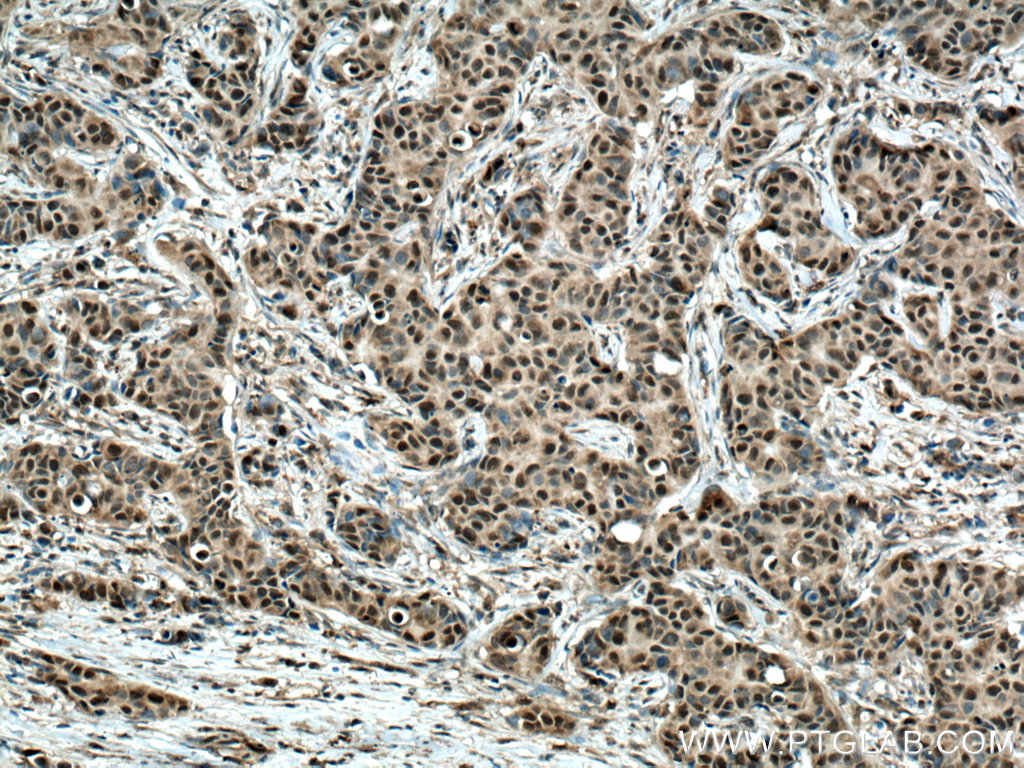 IHC staining of human breast cancer using 20234-1-AP