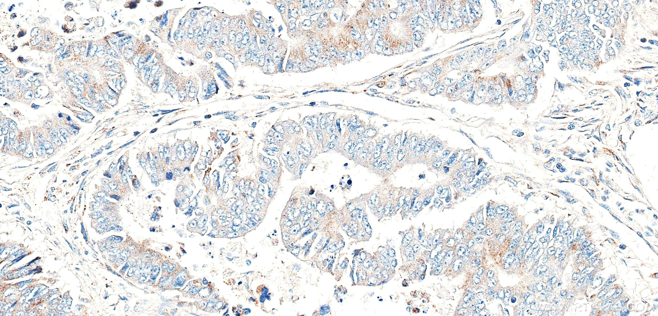 IHC staining of human colon cancer using 86701-1-RR (same clone as 86701-1-PBS) IHC staining of human colon cancer using 86701-1-RR (same clone as 86701-1-PBS)